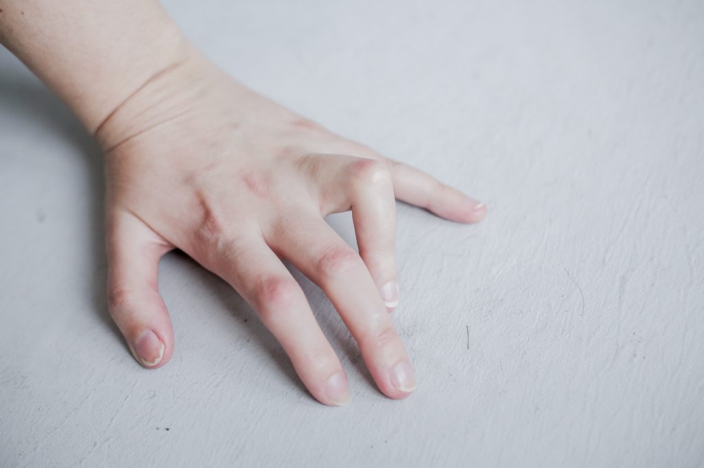 Фото скрюченного пальца из-за псориаза